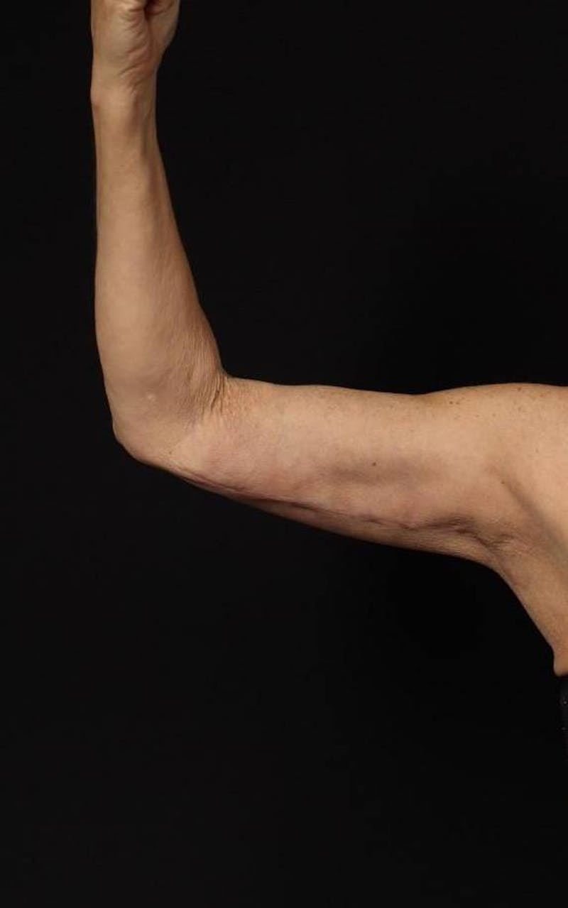 Arm Lift (Brachioplasty) Before & After Gallery - Patient 140345 - Image 4