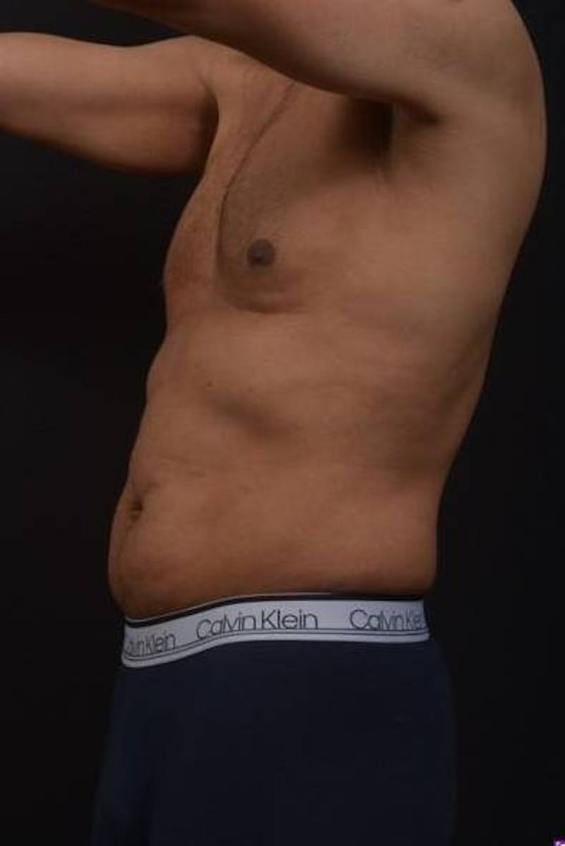 Abdominoplasty Before & After Gallery - Patient 153683 - Image 3