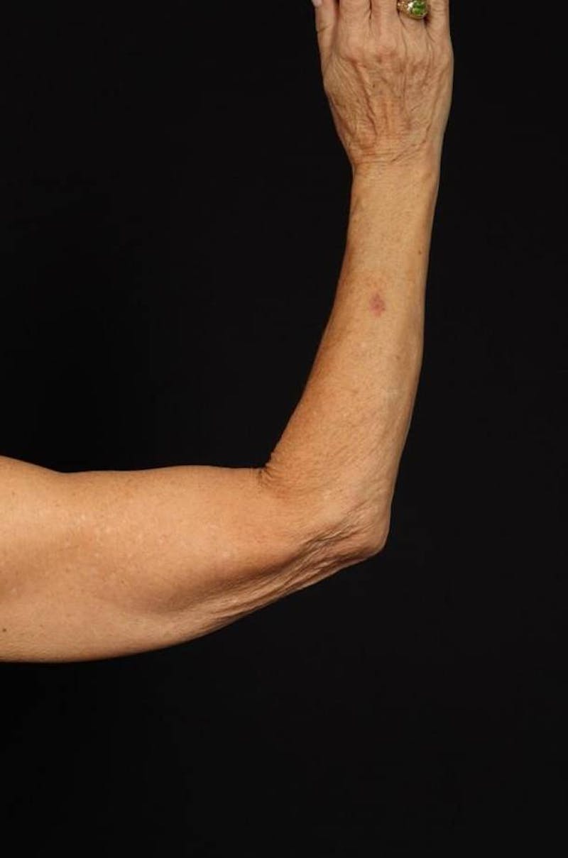 Arm Lift (Brachioplasty) Before & After Gallery - Patient 140345 - Image 7