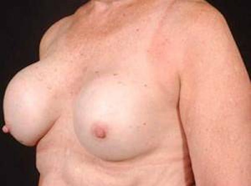 Reconstructive Breast Revision Before & After Gallery - Patient 343310 - Image 5