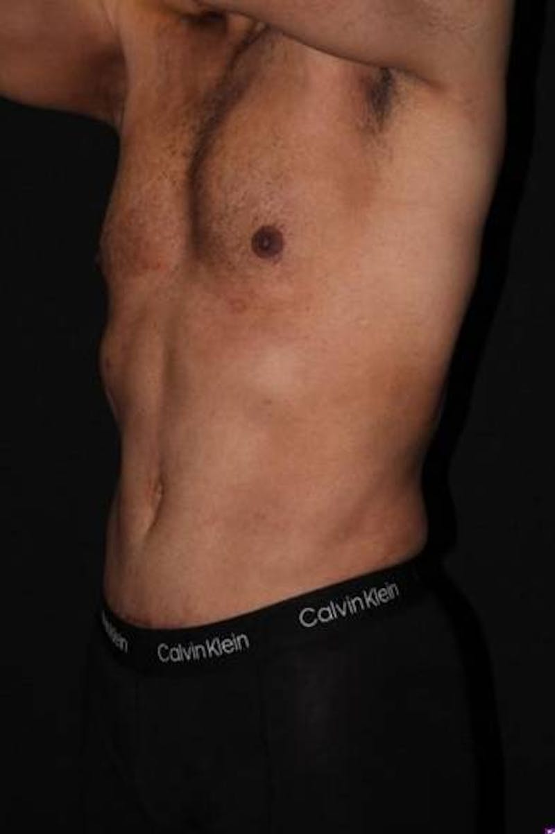 360 Liposuction Before & After Gallery - Patient 190711 - Image 4