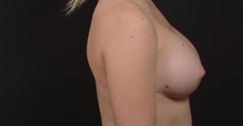 Breast Augmentation Silicone Gel Before & After Gallery - Patient 339085 - Image 4
