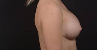 Breast Augmentation Silicone Gel Before & After Gallery - Patient 339085 - Image 4