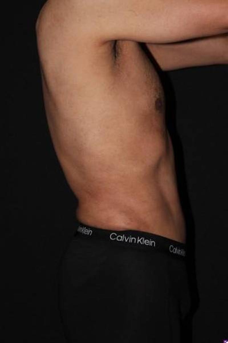 360 Liposuction Before & After Gallery - Patient 190711 - Image 8