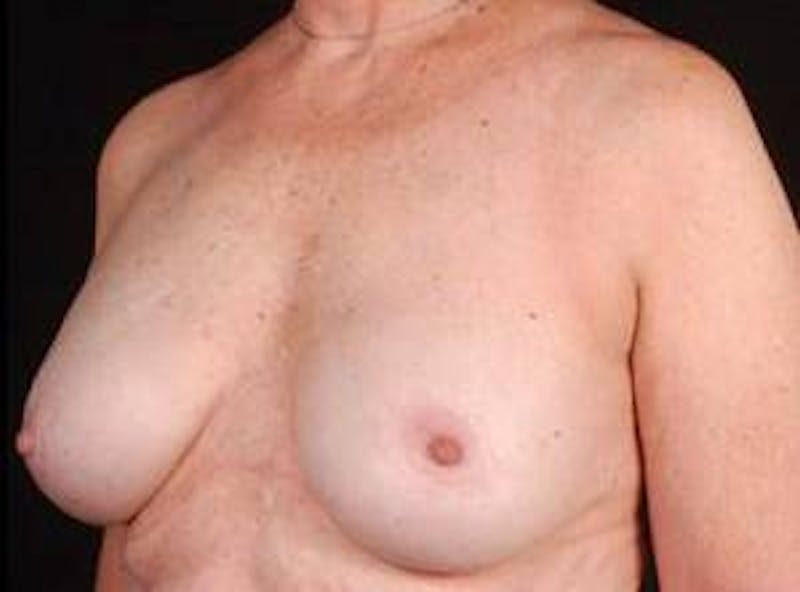 Reconstructive Breast Revision Before & After Gallery - Patient 343310 - Image 6