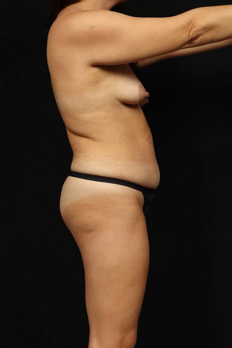 Abdominoplasty Before & After Gallery - Patient 611198 - Image 9