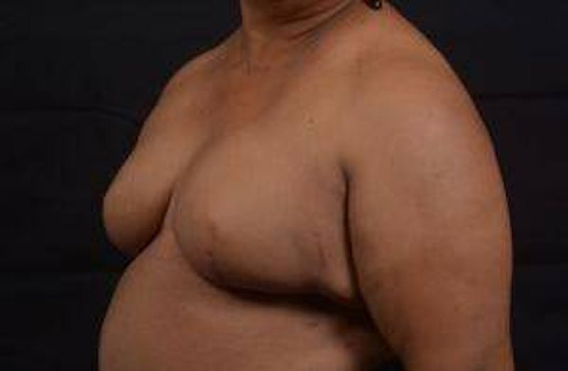 Immediate Breast Reconstruction – Skin Sparing Before & After Gallery - Patient 229008 - Image 7