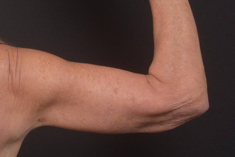 Arm Lift (Brachioplasty) Before & After Gallery - Patient 330764 - Image 8