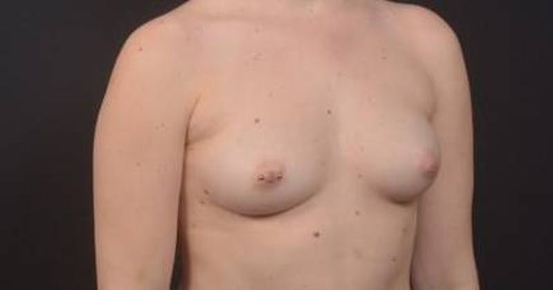 Breast Augmentation Silicone Gel Before & After Gallery - Patient 339085 - Image 5