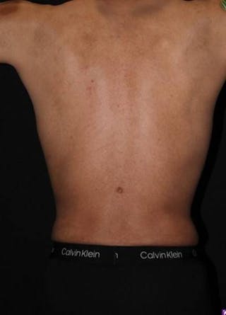 360 Liposuction Before & After Gallery - Patient 190711 - Image 10