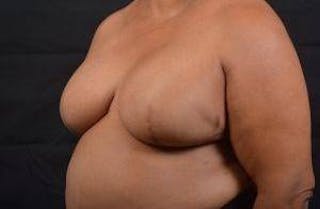 Immediate Breast Reconstruction – Skin Sparing Before & After Gallery - Patient 229008 - Image 8