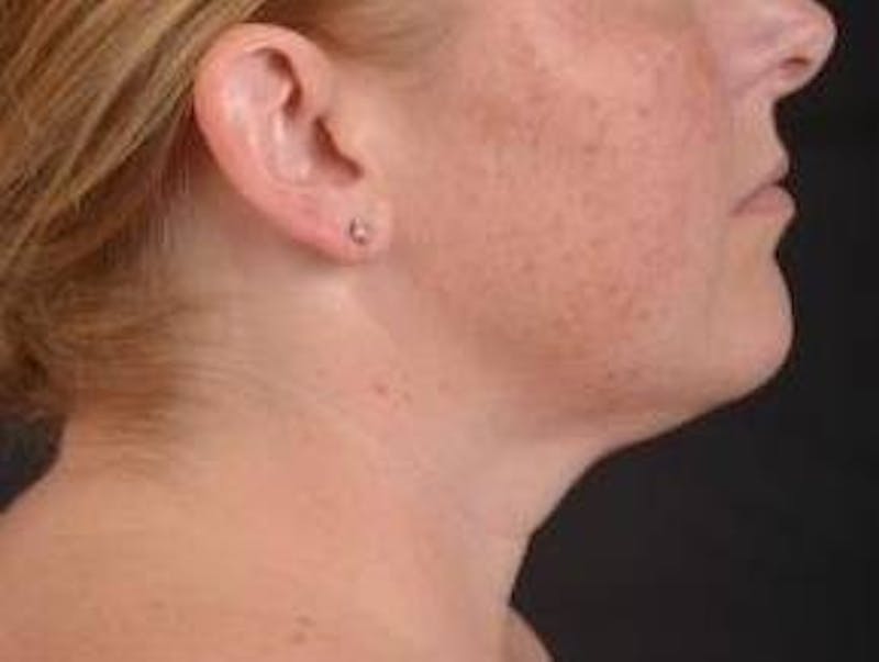 360 Liposuction Before & After Gallery - Patient 289179 - Image 5