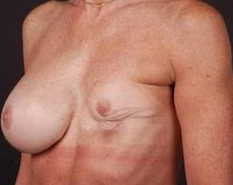 Reconstructive Breast Revision Before & After Gallery - Patient 161874 - Image 3