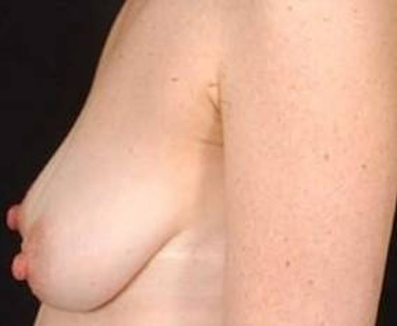 Mastopexy Before & After Gallery - Patient 455749 - Image 3