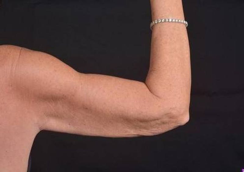 Arm Lift (Brachioplasty) Before & After Gallery - Patient 337372 - Image 3