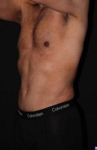 Abdominoplasty Before & After Gallery - Patient 153683 - Image 4