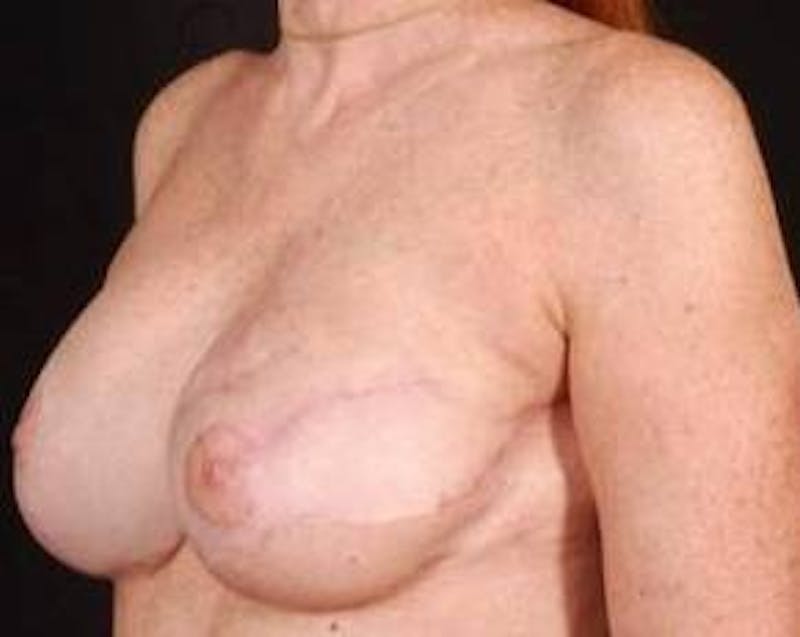 Reconstructive Breast Revision Before & After Gallery - Patient 161874 - Image 4