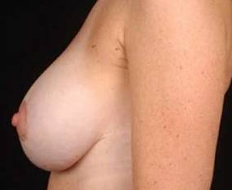 Mastopexy Before & After Gallery - Patient 455749 - Image 4