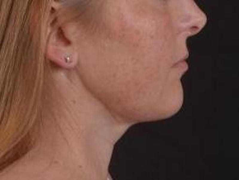 360 Liposuction Before & After Gallery - Patient 289179 - Image 6