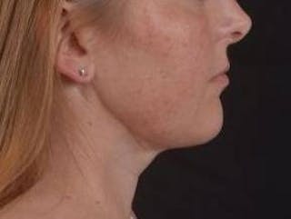 360 Liposuction Before & After Gallery - Patient 289179 - Image 6