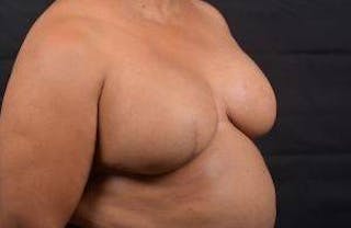 Immediate Breast Reconstruction – Skin Sparing Before & After Gallery - Patient 229008 - Image 10