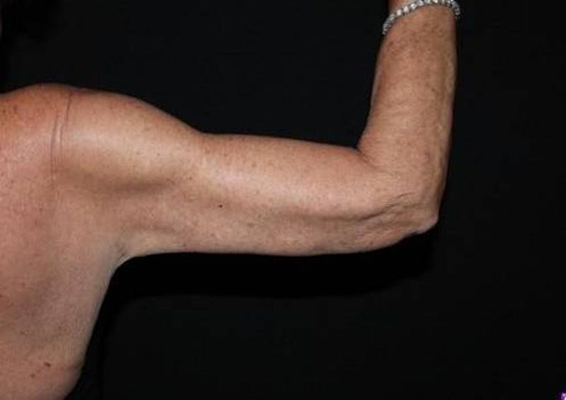 Arm Lift (Brachioplasty) Before & After Gallery - Patient 337372 - Image 4