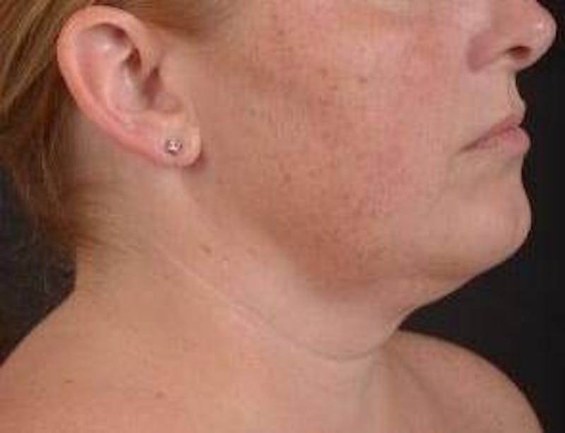 360 Liposuction Before & After Gallery - Patient 289179 - Image 7