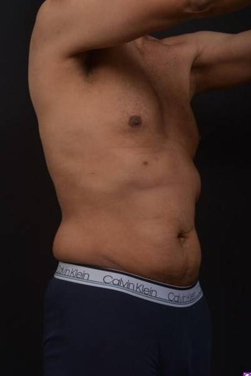 Abdominoplasty Before & After Gallery - Patient 153683 - Image 5