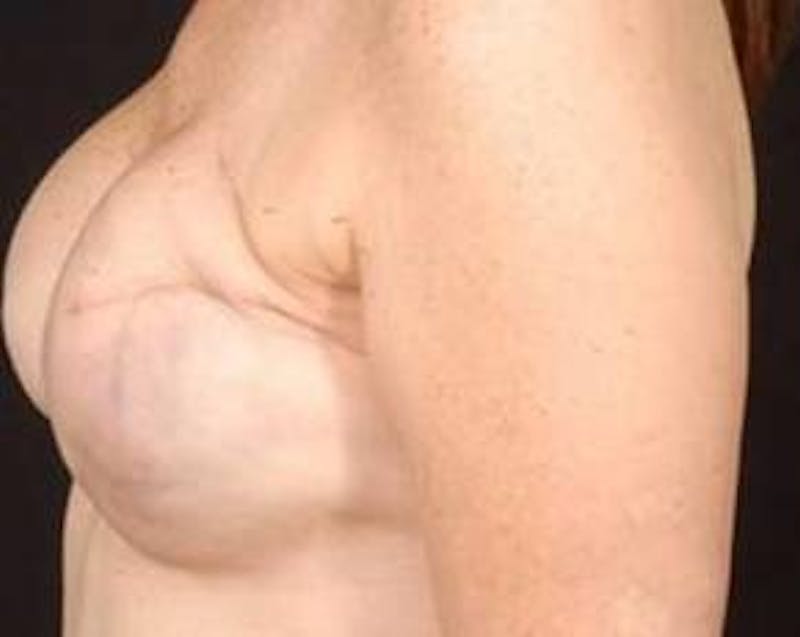 Reconstructive Breast Revision Before & After Gallery - Patient 117846 - Image 3