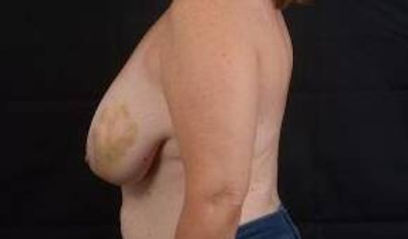 Immediate Breast Reconstruction – Skin Sparing Before & After Gallery - Patient 319356 - Image 3