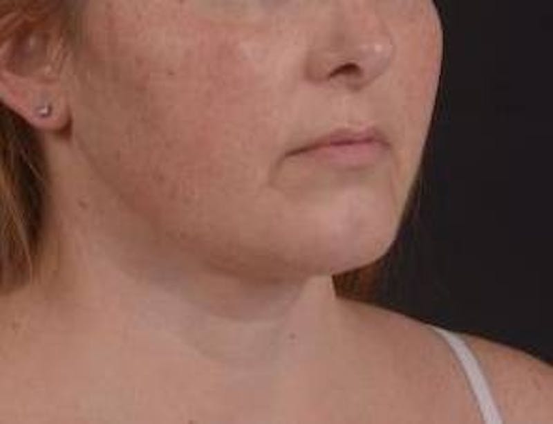 360 Liposuction Before & After Gallery - Patient 289179 - Image 8