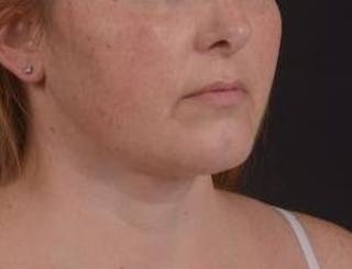 360 Liposuction Before & After Gallery - Patient 289179 - Image 8