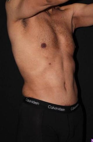 Abdominoplasty Before & After Gallery - Patient 153683 - Image 6