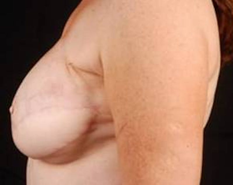 Reconstructive Breast Revision Before & After Gallery - Patient 117846 - Image 4