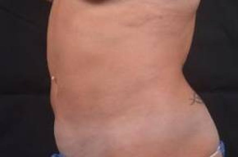 360 Liposuction Before & After Gallery - Patient 124298 - Image 3