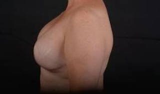 Immediate Breast Reconstruction – Skin Sparing Before & After Gallery - Patient 319356 - Image 4
