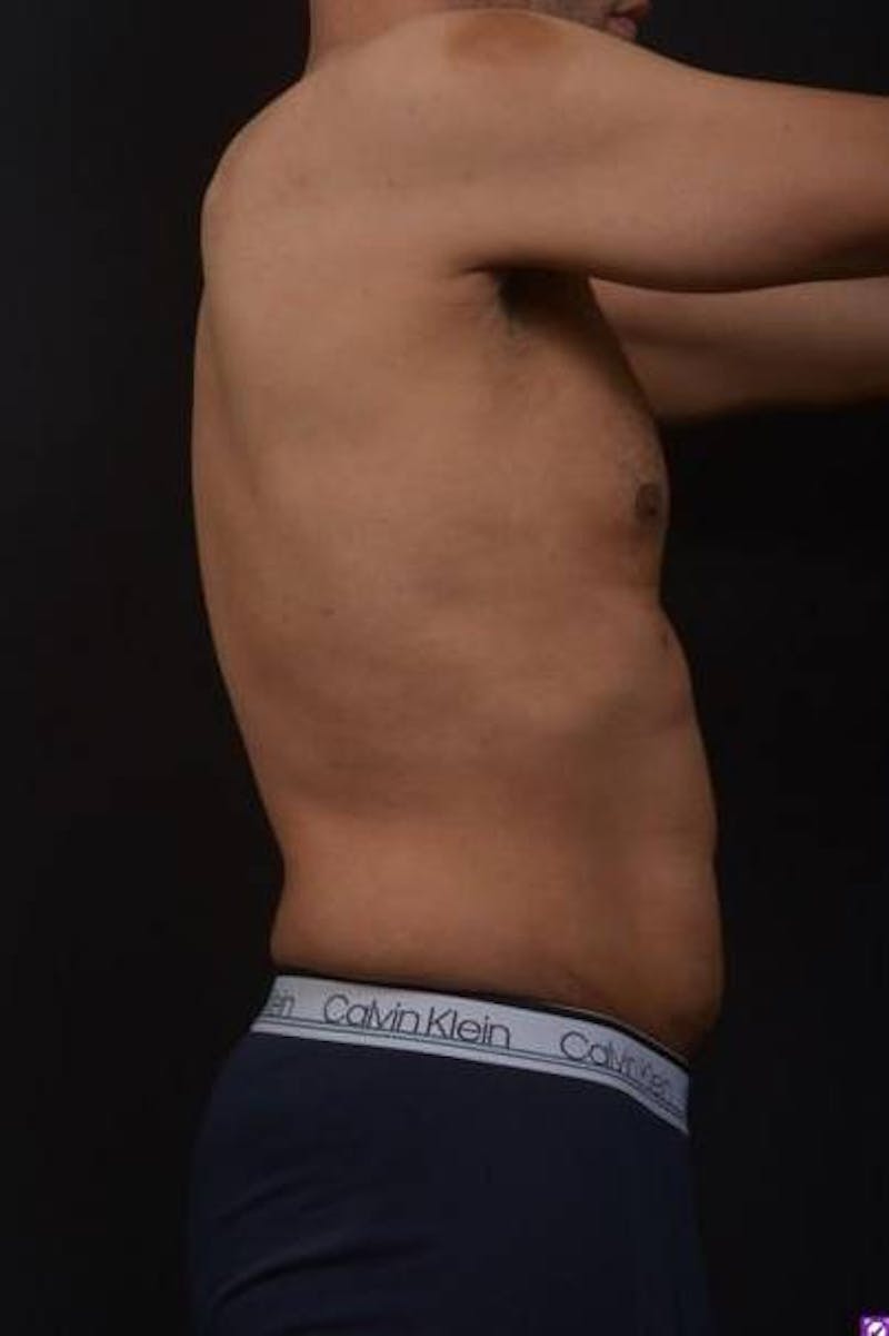 Abdominoplasty Before & After Gallery - Patient 153683 - Image 7