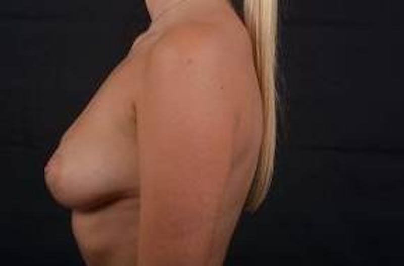 Immediate Breast Reconstruction – Nipple Sparing Before & After Gallery - Patient 292770 - Image 3