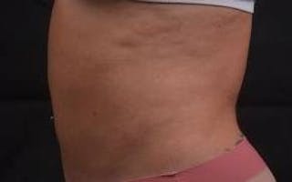 360 Liposuction Before & After Gallery - Patient 124298 - Image 4