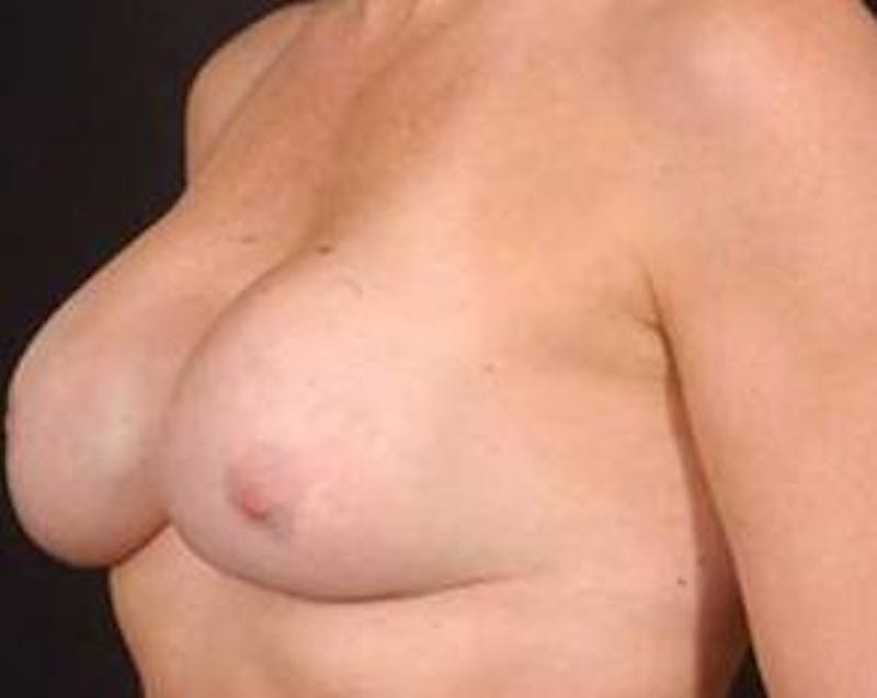 Reconstructive Breast Revision Before & After Gallery - Patient 355816 - Image 3