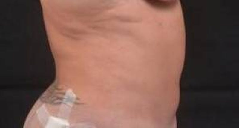 360 Liposuction Before & After Gallery - Patient 124298 - Image 5