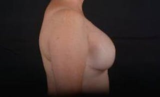 Immediate Breast Reconstruction – Skin Sparing Before & After Gallery - Patient 319356 - Image 6
