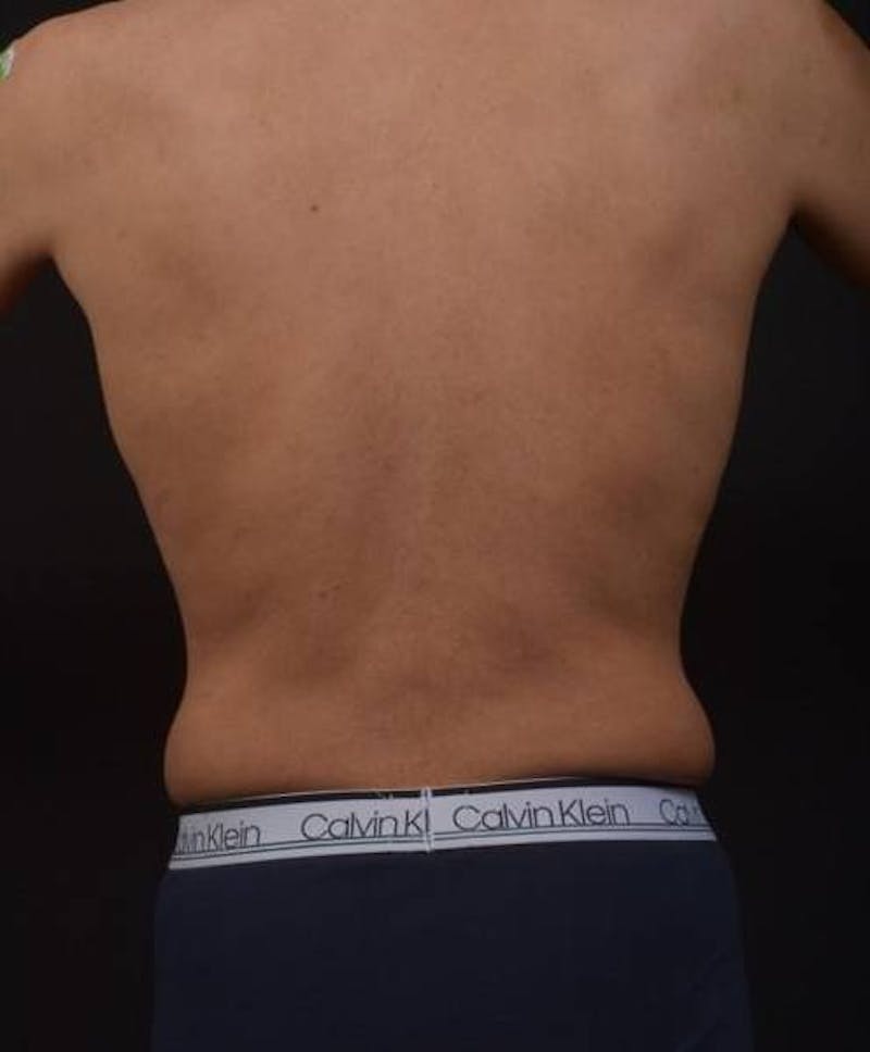 Abdominoplasty Before & After Gallery - Patient 153683 - Image 9