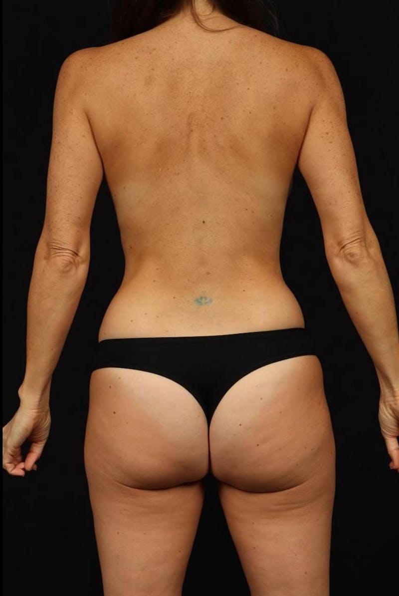 Mommy Makeover Before & After Gallery - Patient 208764 - Image 11