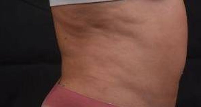 360 Liposuction Before & After Gallery - Patient 124298 - Image 6