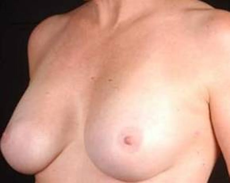 Reconstructive Breast Revision Before & After Gallery - Patient 355816 - Image 4