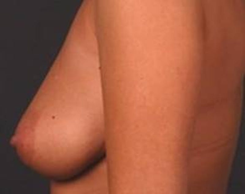 Mastopexy Before & After Gallery - Patient 271546 - Image 3