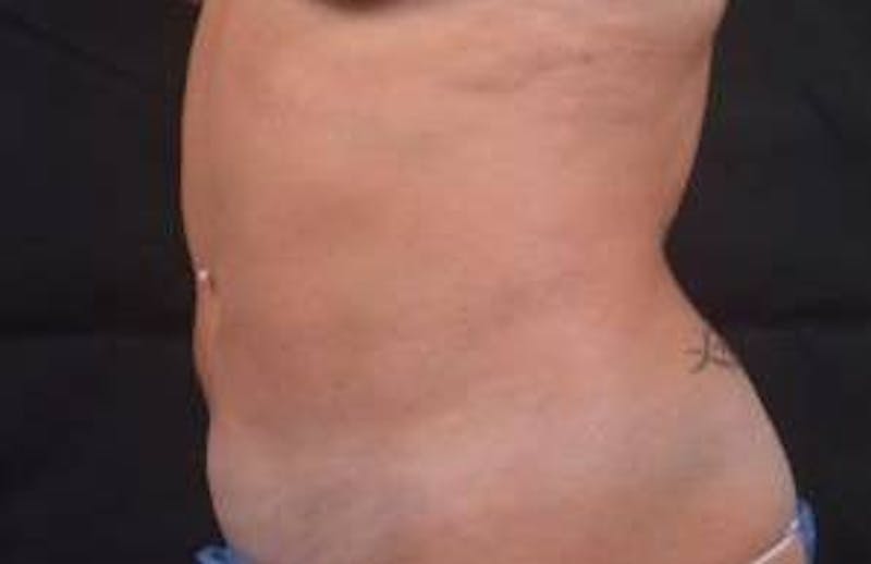 360 Liposuction Before & After Gallery - Patient 124298 - Image 7