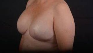 Immediate Breast Reconstruction – Skin Sparing Before & After Gallery - Patient 319356 - Image 8