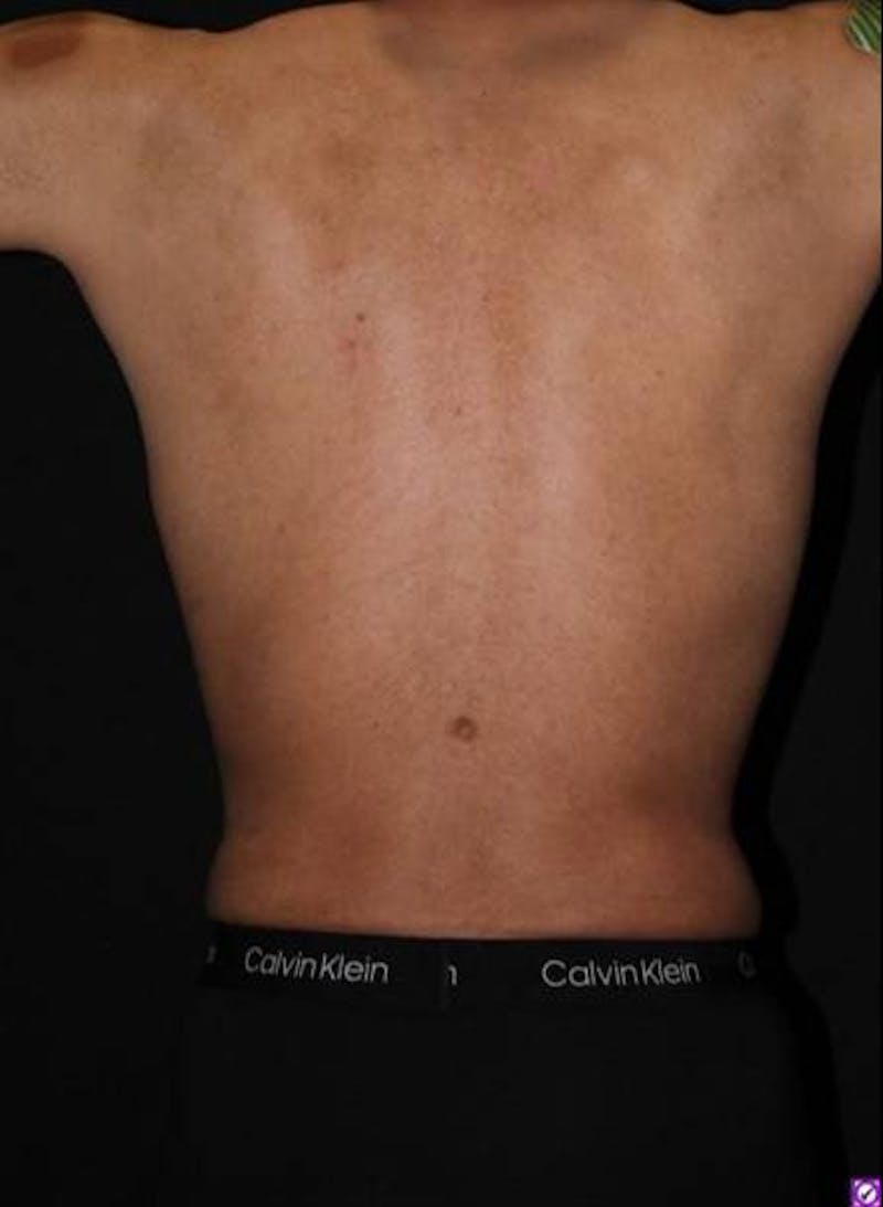 Abdominoplasty Before & After Gallery - Patient 153683 - Image 10
